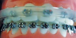 Cover-Ups for Braces, 10/pkg, Cover Up - Metal Braces